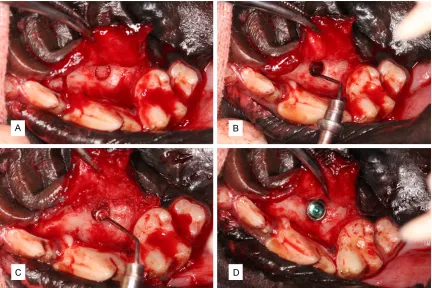 Figure 2. Surgical procedure: A. The implant fossa was drilled in the section. B. The sinus membrane was lifted by using the elevator