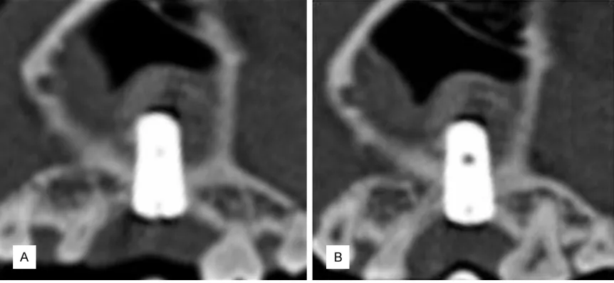 Figure 3. CT examinations: A. Immediate postoperative CT revealed that the implant was located in the middle of the sinus floor