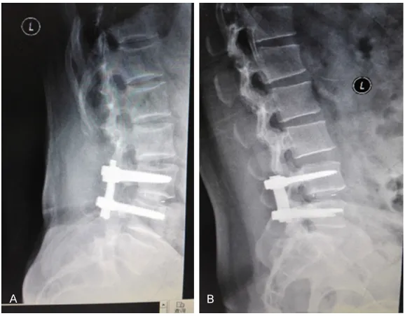 Figure 3. Imaging findings of lateral projection of lumbar vertebrae at 6 months after PLIF (A) and MIS-TLIF (B)