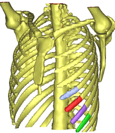 Figure 1. Preoperative chest 3D reconstruction and the selection of the 5th to 8th ribs.
