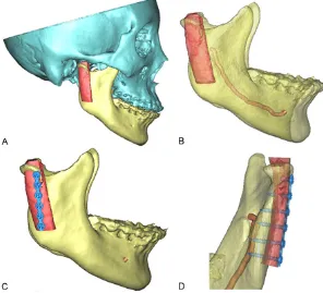 Figure 3. Osteotomy plane for jaw segmentation and trimming. A. Osteotomy plane 1 for condylar neck; B