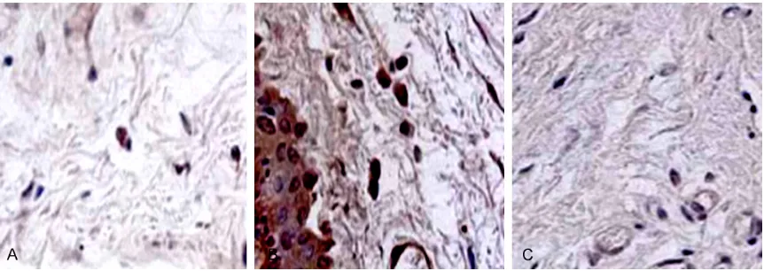 Figure 1. Immunohistochemical staining of VEGF in filtration tissues after operation. A: Postoperative 3 d; B: Post-operative 7 d; C: Postoperative 14 d.