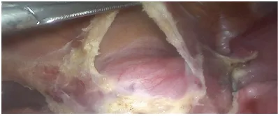 Figure 1. There was no dense or only loose adhesion formed between the bladder and cervix.