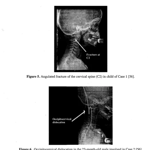 Figure 5. Angulated fracture of the cervical spine (C2) in child of Case 1 [56]. 
