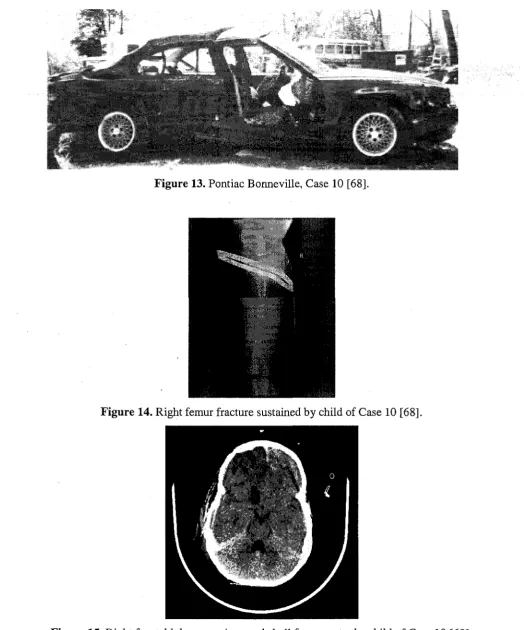 Figure 15. Right frontal lobe contusions and skull fractures to the child of Case 10 [68]