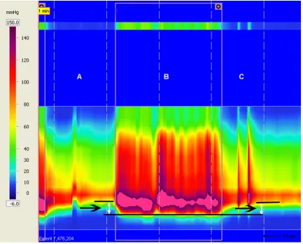 Figure 1. Downward and upward movements of the high-pressure zone during the defecation