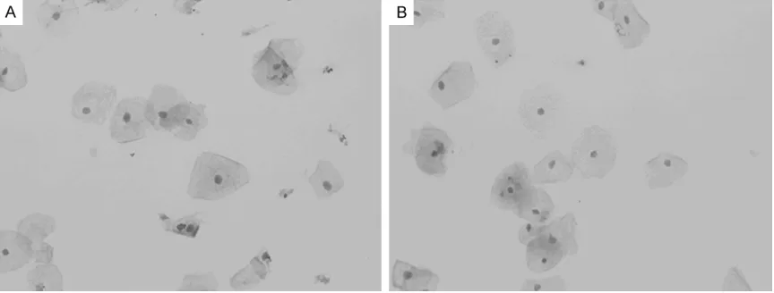 Figure 1. The expression of DNMT1 protein. A: Positive expression of DNMT1 protein ×400; B: Negative expression of DNMT1 protein ×400.