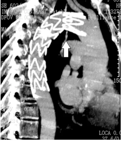 Figure 5. An aorta stent was planted in the descend-ing aorta, bronchial artery angiography showed dis-appearance of the BAA but microcoils.