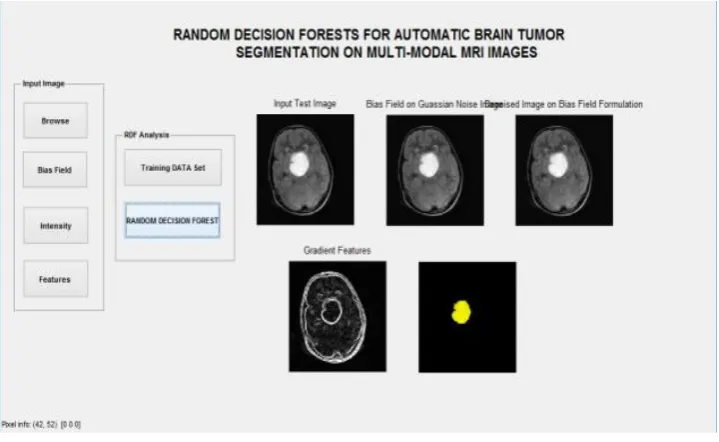 Figure.5 Detection of tumour from given input image  