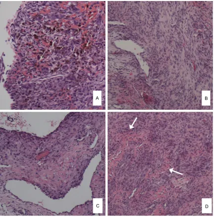 Figure 2. Pathological examination of the recurrent lesion. A and B: Specimen in January 2013 showing spindle cells and multinucleated giant cells and “vascular” form in the lesion