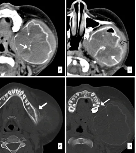 Figure 3. Images depicting of the lesion (June 2013). A: Wave-like pattern of cortical bone and calcified foci (arrow)
