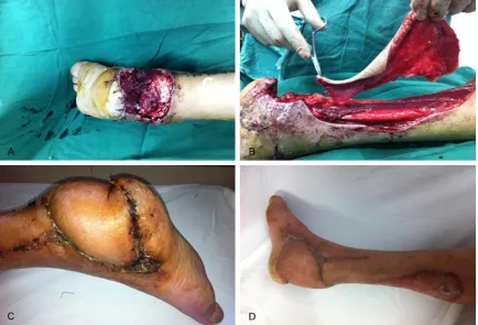 Figure 2. A: A defect with exposed calcaneus in the heel. B: Harvesting of a posterior tibial artery perforator flap