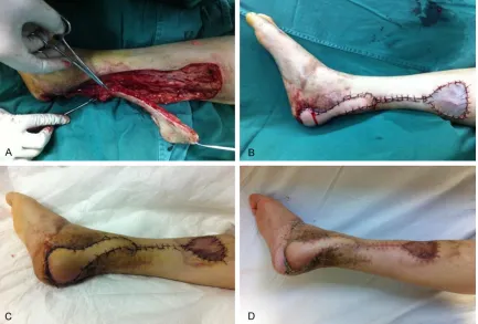 Figure 3. A: Harvesting a posterior tibial artery perforator flap. B: The flap was turned about 180 degrees to fill the calcaneus cavity and skin graft was performed