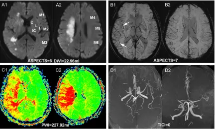 Figure 1. Representative MRI of a 68-year-old man with SWI-DWI mismatch. The 10 ASPECTS regions shown in A1 and A2 are M1-6 cortical regions of MCA (M1-3 at the basal ganglia level, M4-6 at the rostral level to the gan-glionic structures)
