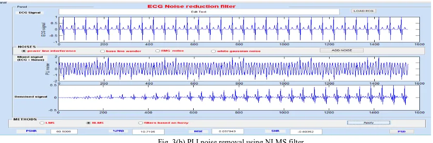Fig. 3(b) PLI noise removal using NLMS filter  