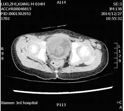 Figure 2. Cystoscopic examination of the bladder mass. Under the cystoscope, a solid smooth and pale tumor with the size of 6.0 cm × 5.5 cm occupied almost the whole bladder cavity.