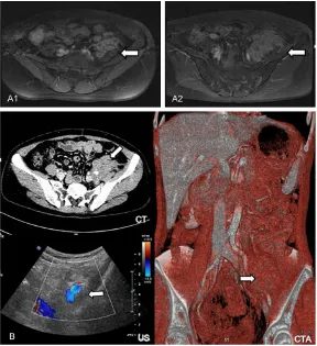 Figure 1. Imaging manifestations. A1. Axial post-contrast T1-weighted im-age shows a heterogeneous enhancement mass in the left psoas major