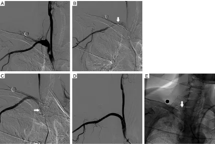 Figure 3. The digital subtraction angiography demonstrated a right proximal subclavian artery stenosis associated with subclavian artery aneurysms and the ostia of right vertebral artery exactly located in the aneurysm (A)