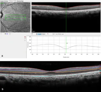 Fig 2. Positioning of software caliper for lateral retinal thickness measurement.