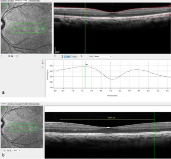 Fig 3. a and b. Measurement of foveal width. Maximum retinal thickness nearest to the foveal reflex on nasal(a) and temporal side identified from the thickness profile