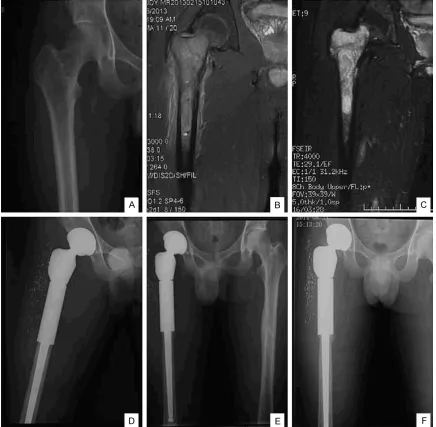 Figure 2. Case presentation: A 24-year-old male patient with Ewing’s sarcoma in right proximal femur