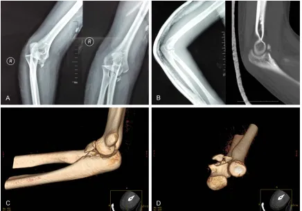 Figure 1. X-ray and 3D computed tomography (CT) examinations for elbow joint before surgery