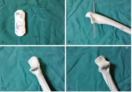 Figure 2. The operation steps of loop plating technique. A: Self-made loop plating and 2# ETHIBOND suture
