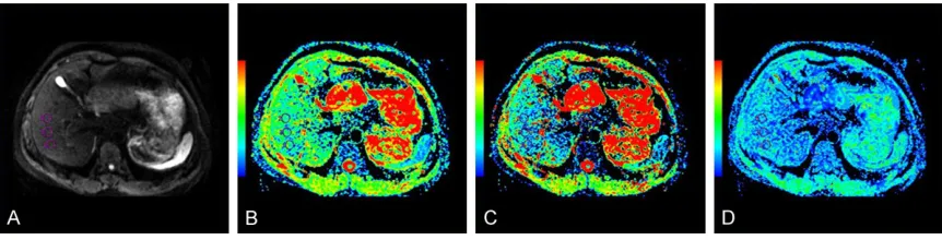 Figure 2. Characterization of a 51-year-old female patient with no fibrosis (F0). A. Multiple b-value DWI map of F0