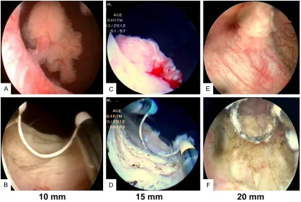 Figure 1. Images of bladder tumors were captured pre-operatively under cystoscopy (A, C and E)