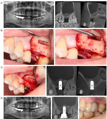 Figure 1. A: Severely resorbed posterior maxilla, the residual bone height is only 1 to 2 mm; B: A slot-like window in the lateral sinus wall; releasing and elevating the sinus membrane through the bony window; C: Graft materials were packed into the void 