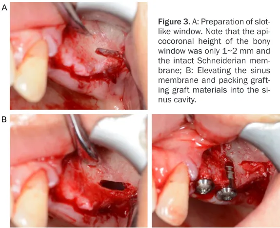 Figure 2. A: Extremely resorbed and pneumatized posterior maxilla. Note the less than 1 mm alveolar bone height remained