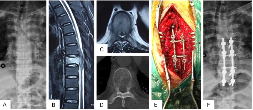 Figure 1. A 62-year-old man who was unable to walk due to metastatic spinal cord compression (MESCC) resulted from lung cancer