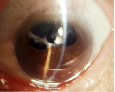 Figure 1. Anterior segment photography of eye under mydriasis preoperatively. The eye occurred CCS after cataract phacoemulsification following trabeculecto-my, hyperplasia and thickening of 270 degree fibrous ring in the area of anterior capsule opening l