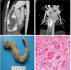 Figure 3. Patient 3 (female, 31 years old). A. The soft tissue density mass located in the right ventricle and right atrium extended into pulmonary artery, the inferior vena cava, and right iliac vein