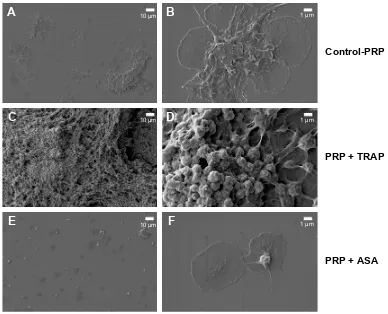 Figure 2 Quartz crystal microbalance with dissipation. Effects of TRAP and ASA on platelet microaggregation.Notes: (A) Quantitative analysis of the effects of TRAP on frequency f and energy dissipation D