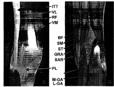 Figure 3. A) Anterior view of knee musculature: ITT- iliotibial tract, VL-vastus lateralis, RF- rectus femoris, VM-vastus medialis, PL-patellar ligament