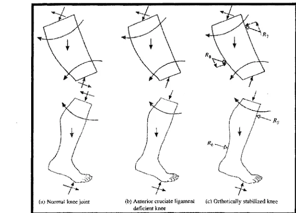 Figure 10. The forces acting on the weight-bearing lower extremity with the knee flexed for the normal leg (A), the ACL deficient knee (B) and the orthotically stabilizes knee (C) (Liggins and Bowker, 1991).