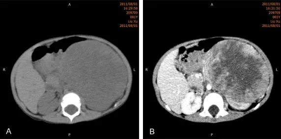 Figure 5. Initial abdominal CT of case 2. A: CT plain scan, B: CT contrast enhanced scan