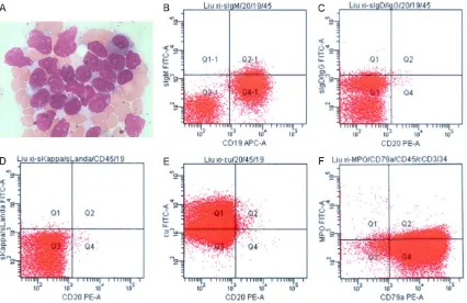 Figure 6. Bone marrow hemocytology (A) and flow cytometry (B) of Case 2. (A) The result revealed an abnormal increase in the amount of lymphoblast and Immature lymphocytes (36% and 95%, respectively)