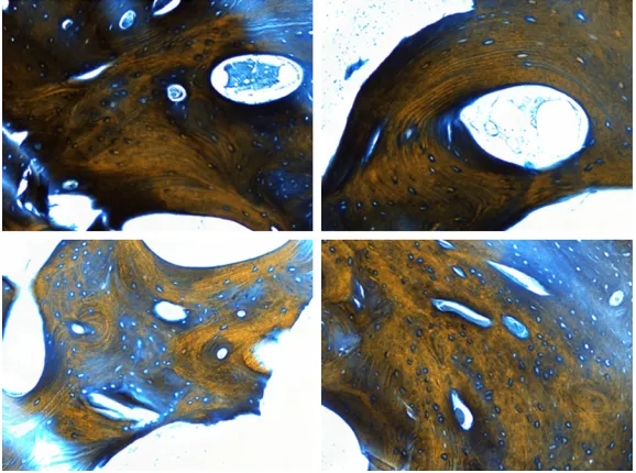 Figure 6. Immunohistochemical evaluation of Osteocalcin in some repre-sentative areas of the biopsy sample