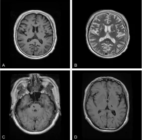 Figure 2. Representative MRI images showing lacunar infarcts (LIs) and white matter lesions
