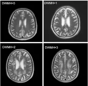 Figure 3. Representative MRI images showing periventricular hyperintensity signals (PVH; graded 0 to 3).