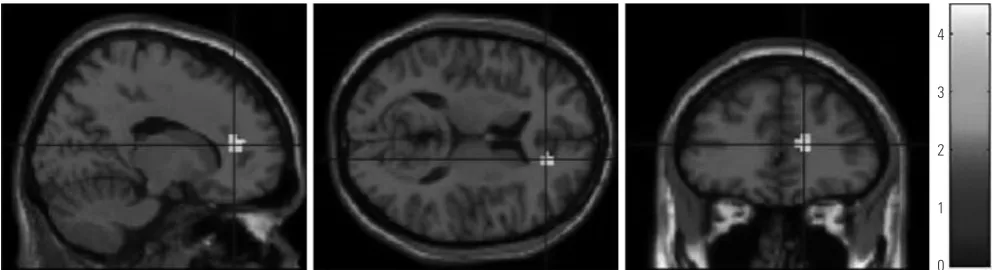 Fig. 1. Coordinates of a voxel exhibiting lower functional connectivity within the default mode network in the low-empathy empathy group, compared to the medium empathy group (x=15, y=39, z=15, t=4.51, k=23 voxels, uncorrected p<0.001).