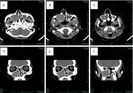 Figure 1. Axial (A-C) and coronal (D-F) CT scan demonstrated an heterogeneous soft-tissue mass occupying the entire right maxillary sinus with erosion of orbital floor, medial, anterior, inferior and posterior walls