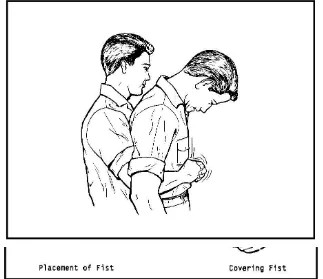 FIGURE 5-2.  HAND PLACEMENT FOR ADMINISTERING AN ABDOMINAL THRUST