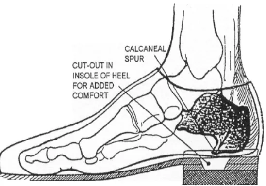 Figure 2-8.  Calcaneal spur syndrome. 