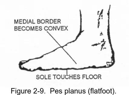 Figure 2-9.  Pes planus (flatfoot). 