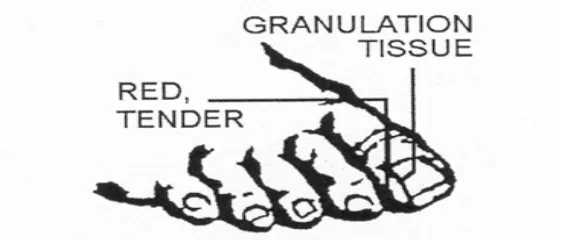Figure 2-11.  Ingrown toenail. 