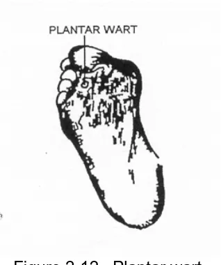 Figure 2-12.  Plantar wart. 