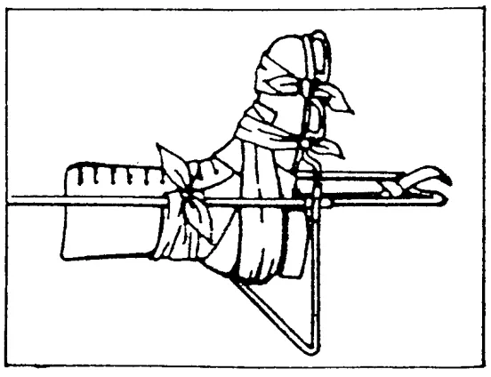 Figure 3-7.  Five cravats applied to the casualty's leg. 
